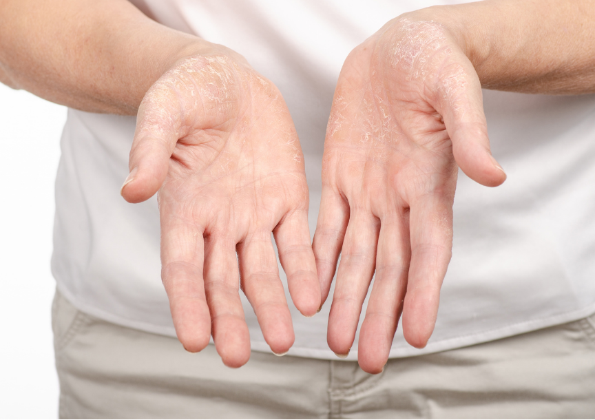 Tips para prevenir la Resequedad o Dermatitis en manos. Agenda hora con un especialista en dermatología en Andes Salud Ancud