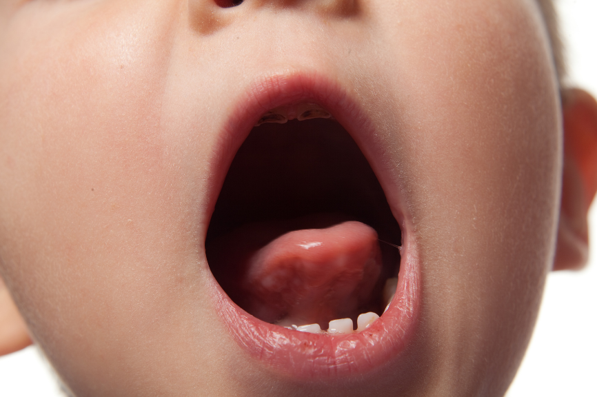 Consulta médica para Evaluación del frenillo lingual en un bebé o niños para mejorar la alimentación y el desarrollo maxilofacial.