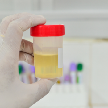 Examen de orina y urocultivo para el diagnostico de infecciones urinarias. Realiza tus exámenes en Andes Salud Ancud, Chiloé.