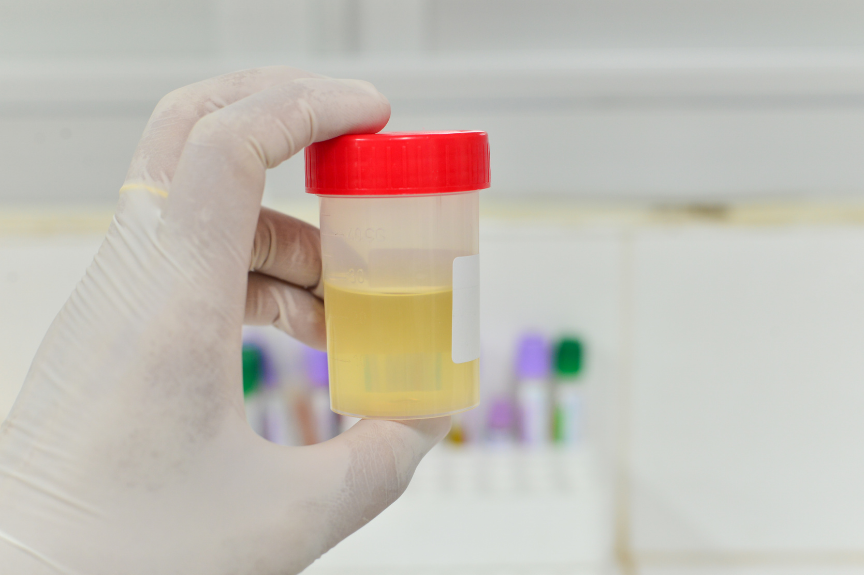 Examen de orina y urocultivo para el diagnostico de infecciones urinarias. Realiza tus exámenes en Andes Salud Ancud, Chiloé.